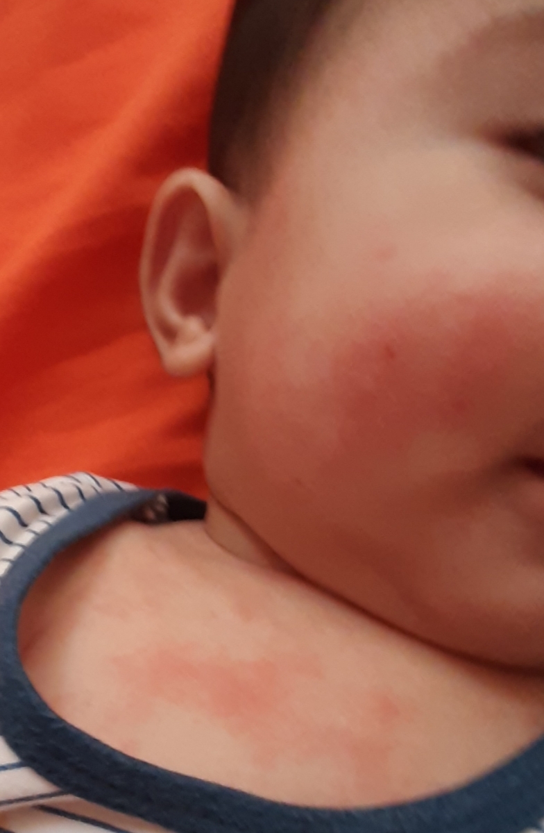 حساسیت و اگزما نوزاد در قسمت صورت و سینه و دستها