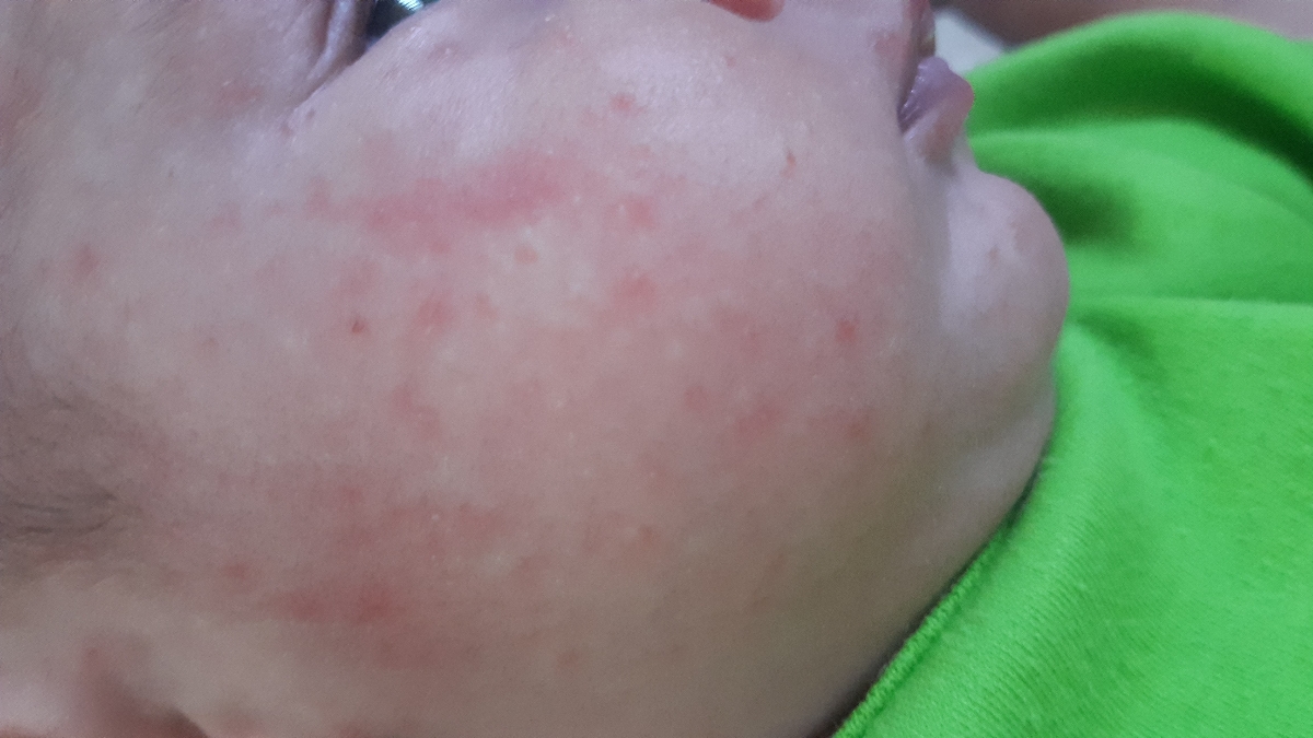 بچهاا چی بزنم به صورت دخترم؟😢