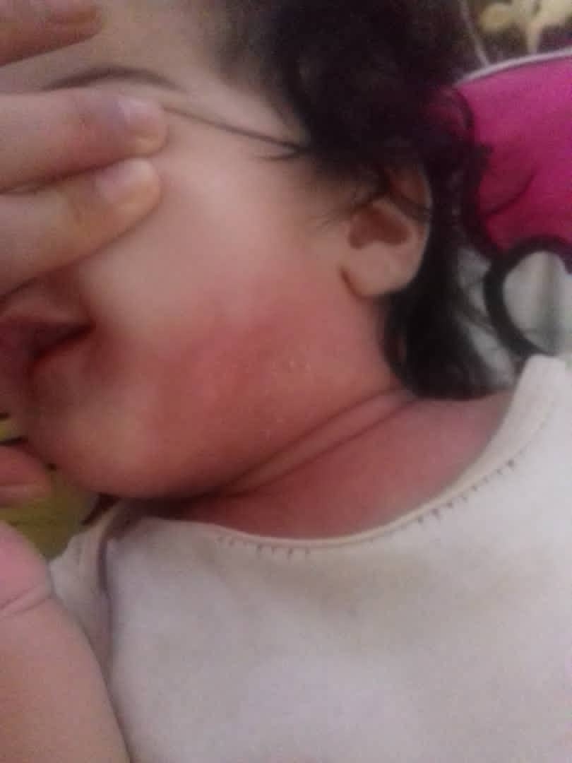 قرمزی روی پوست دخترم🥺همراه عکس قرمزی روی پوست دخترم🥺همراه عکس