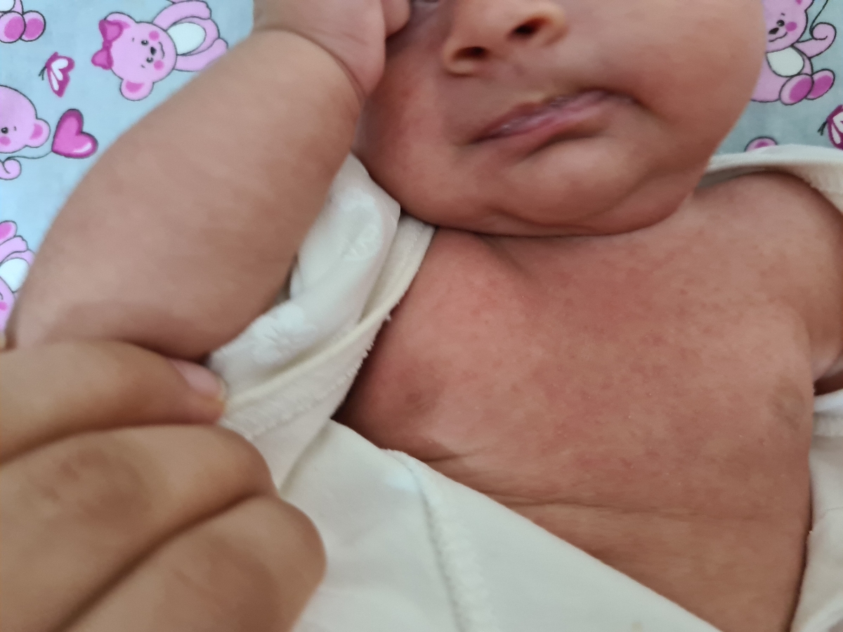 جوش روی بدن و سر و صورت نوزاد جوش روی بدن و سر و صورت نوزاد