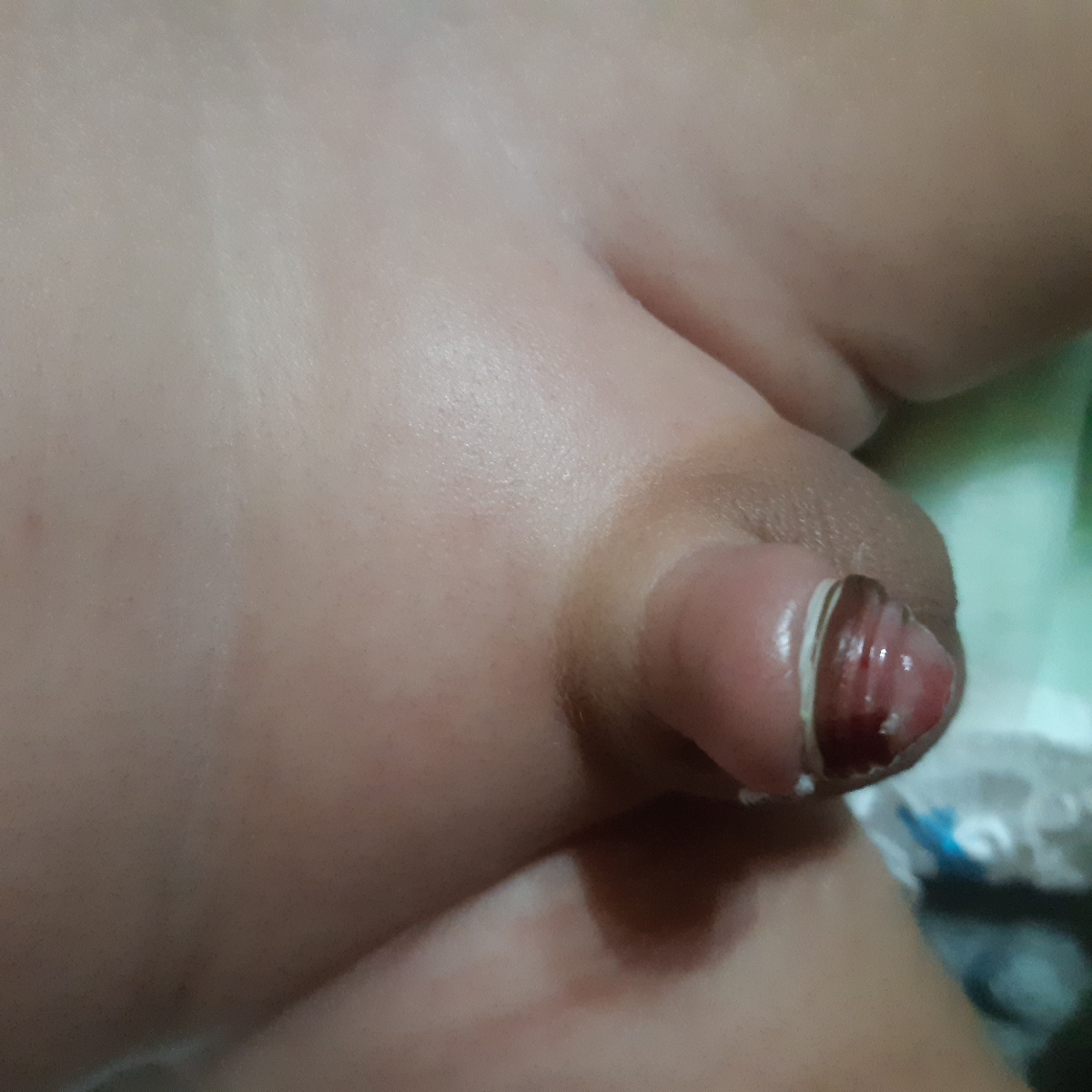 ختنه نوزاد + عکس ختنه نوزاد + عکس