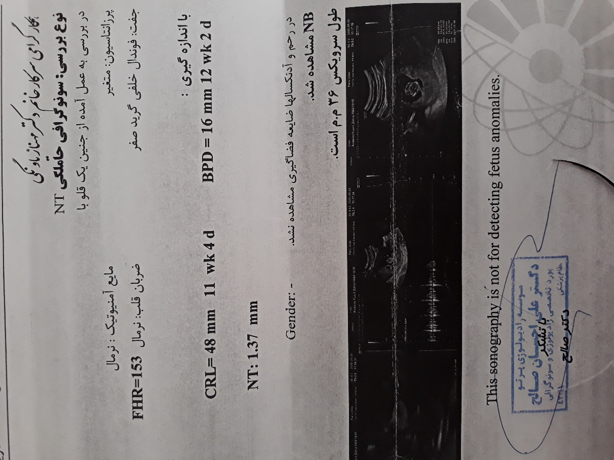 سونوگرافی انومالی و وجود رسوب در بطن چپ قلب جنین سونوگرافی انومالی و وجود رسوب در بطن چپ قلب جنین