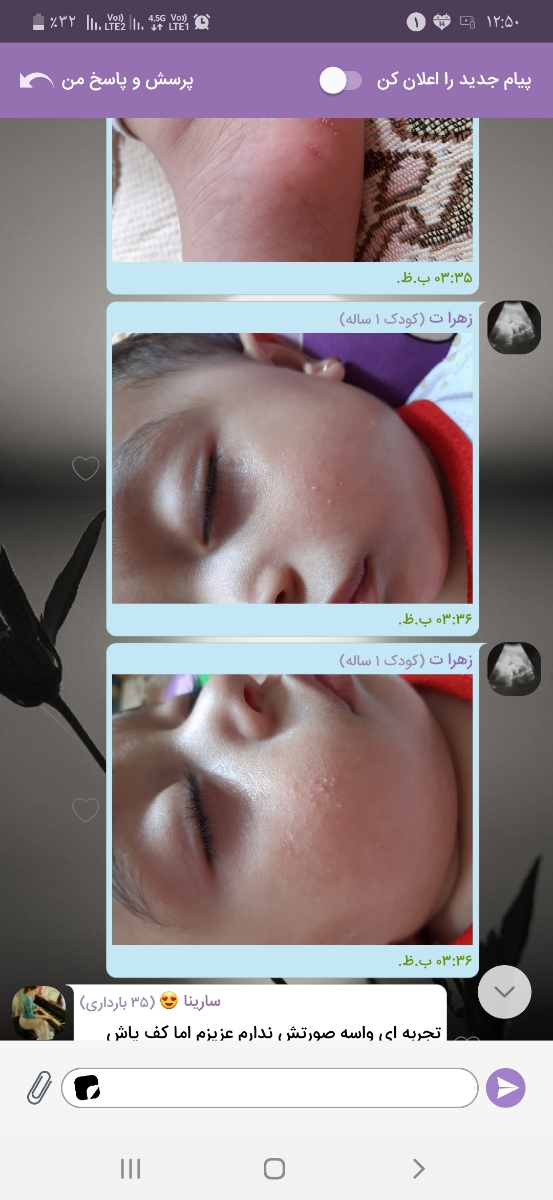 رفع نشدن جوش صورت رفع نشدن جوش صورت
