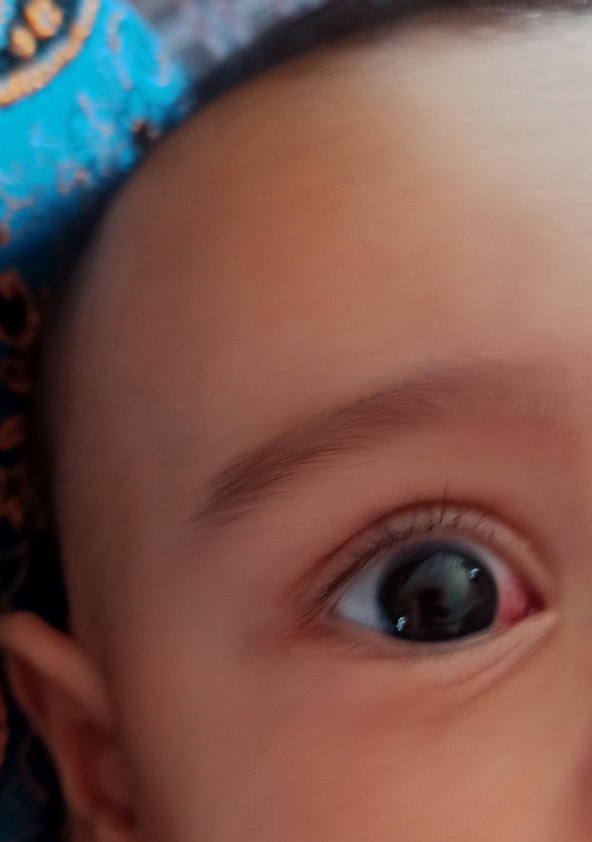 قرمزی چشم نوزاد .