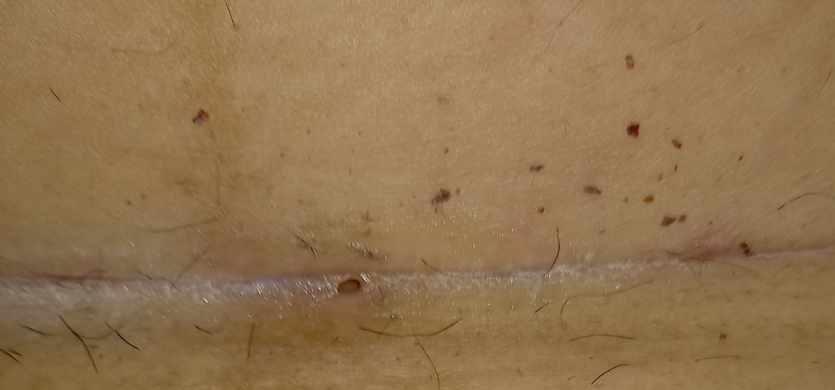 سوراخ روی بخیه سزارین
