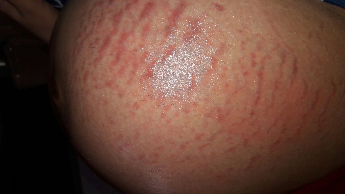 حساسیت به جفت و خارش بدن حساسیت به جفت و خارش بدن