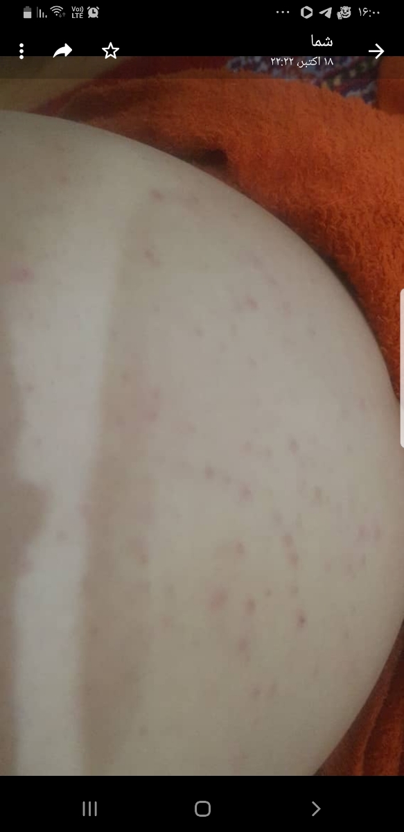 حساسیت به جفت و خارش بدن حساسیت به جفت و خارش بدن