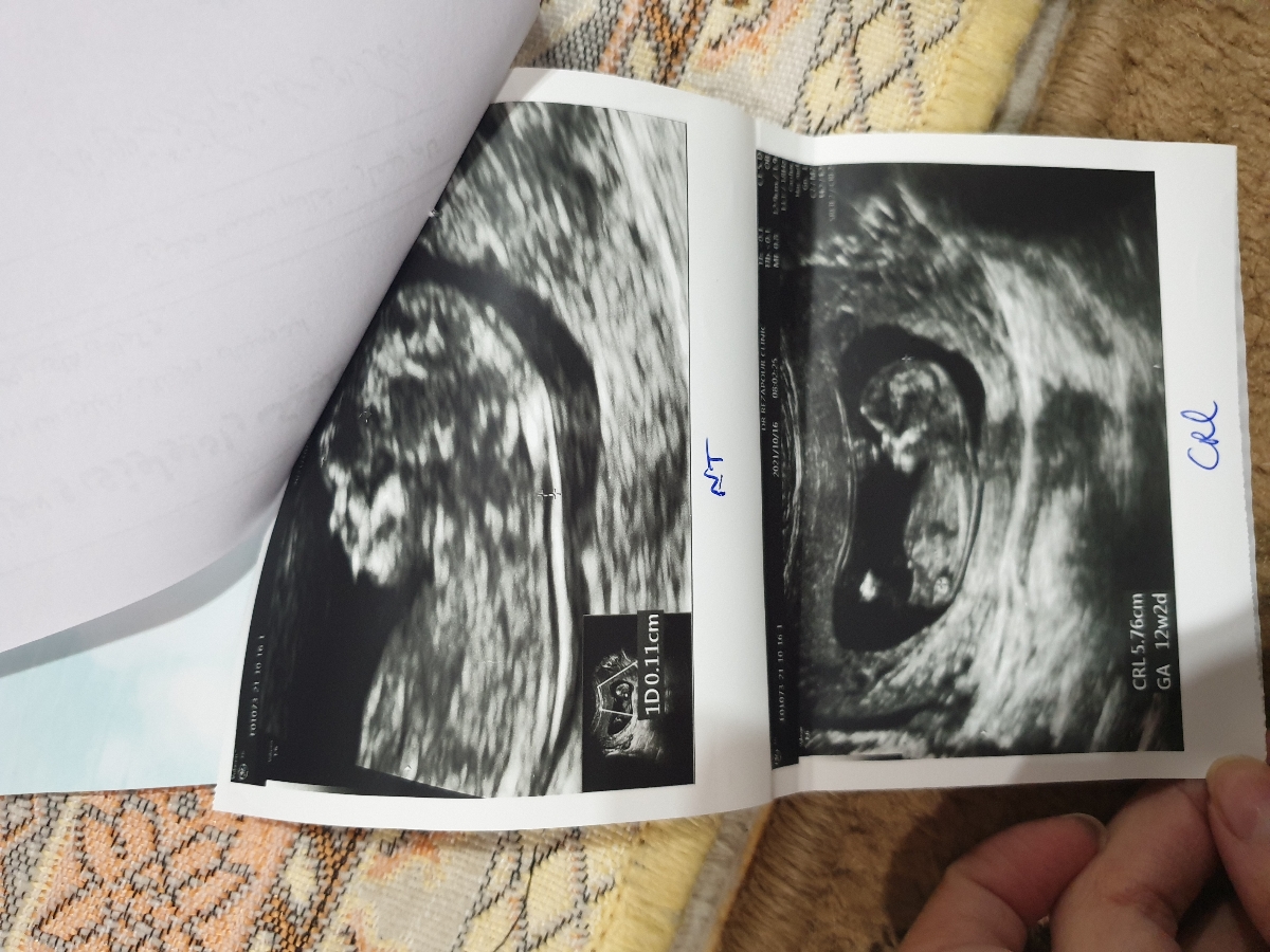 تشخیص جنسیت جنین تشخیص جنسیت جنین