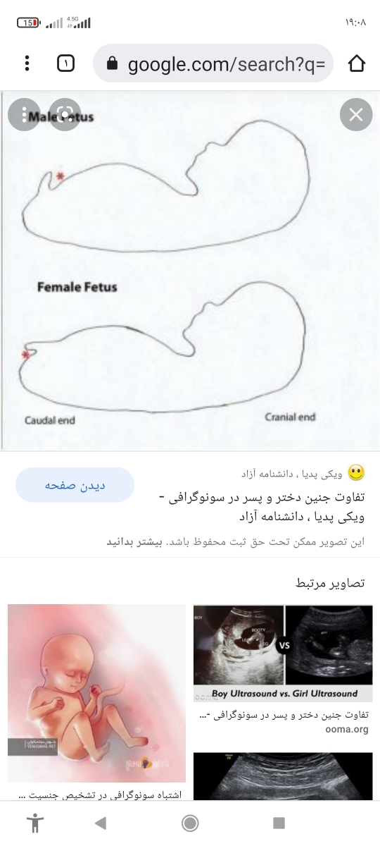 تشخیص جنسیت جنین تشخیص جنسیت جنین