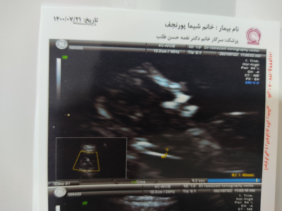 تشخیص جنسیت جنین تشخیص جنسیت جنین