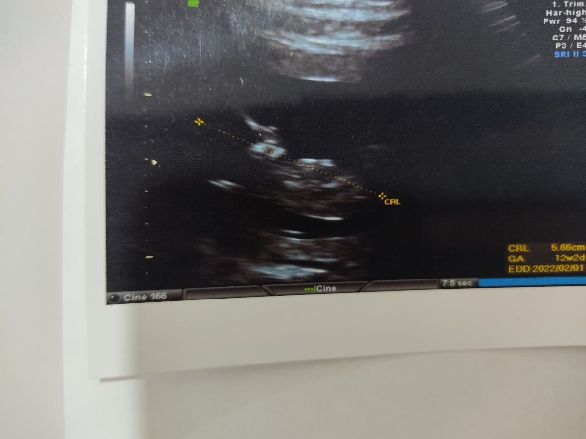 تشخیص جنسیت جنین تشخیص جنسیت جنین