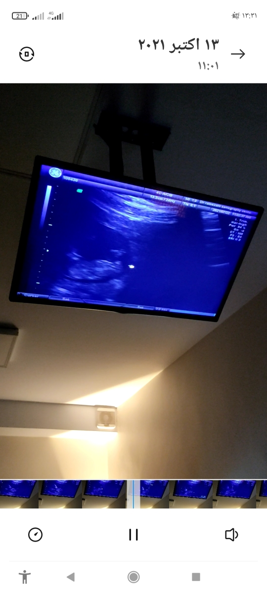 تشخیص جنسیت جنین تشخیص جنسیت جنین