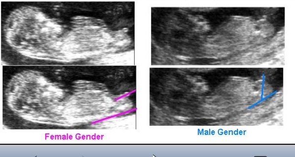 تشخیص جنسیت جنین تشخیص جنسیت جنین