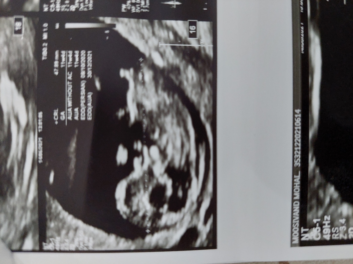 تشخیص جنسیت جنین تشخیص جنسیت جنین