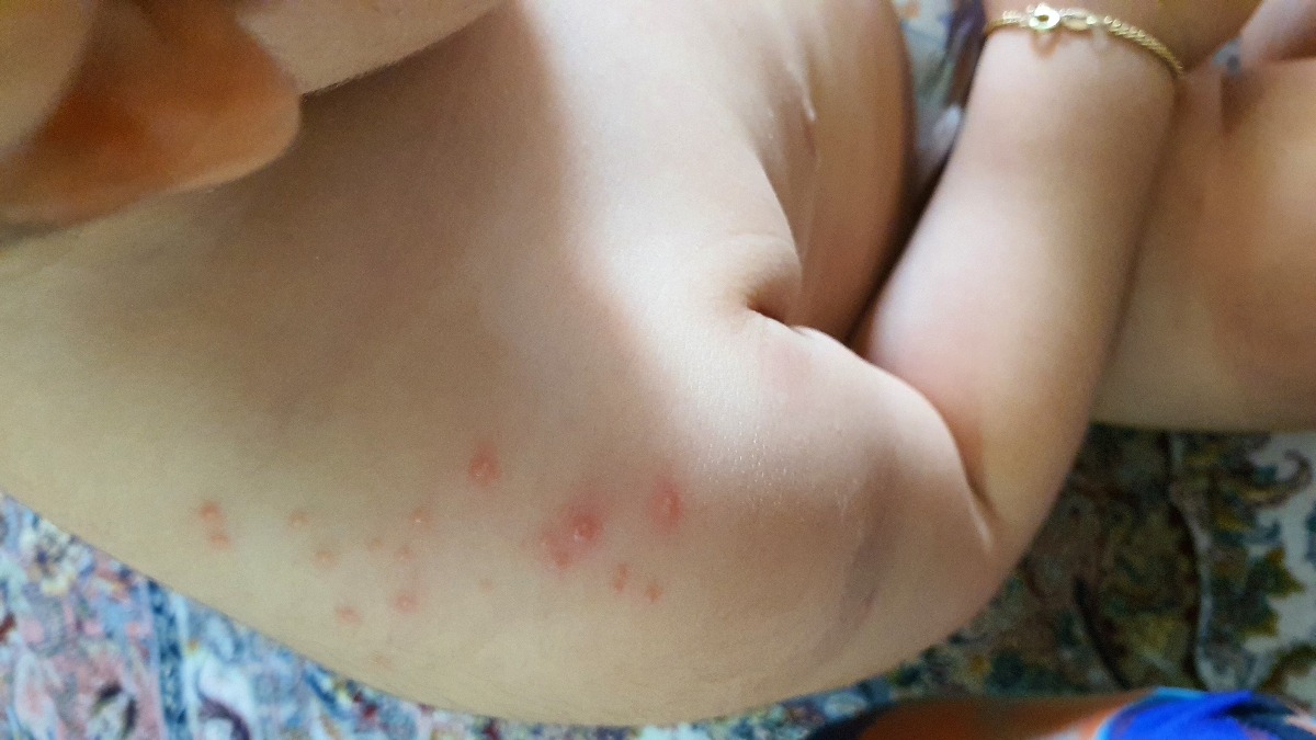 روی شانه و پای دخترم دانه زده ممکن به موز حساسیت داشته باشه یامال خرما روی شانه و پای دخترم دانه زده ممکن به موز حساسیت داشته باشه یامال خرما