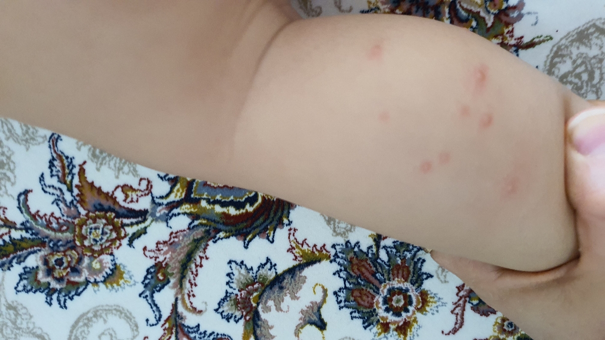 روی شانه و پای دخترم دانه زده ممکن به موز حساسیت داشته باشه یامال خرما روی شانه و پای دخترم دانه زده ممکن به موز حساسیت داشته باشه یامال خرما