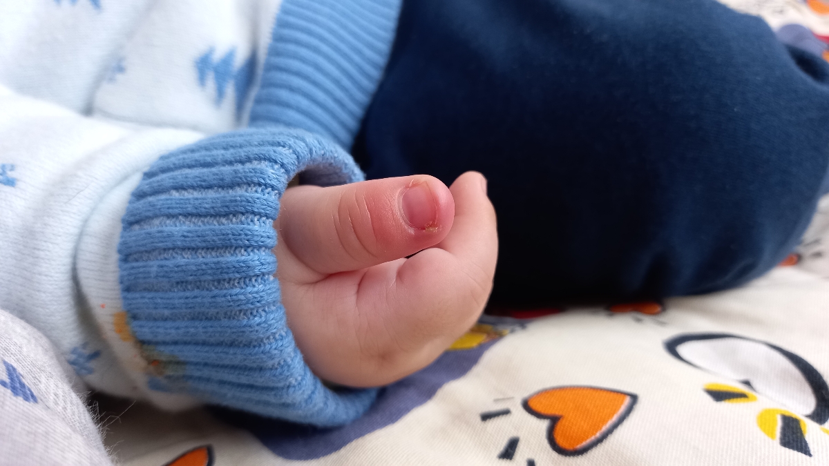 چرک کردن ناخن نوزاد چهار ماهه