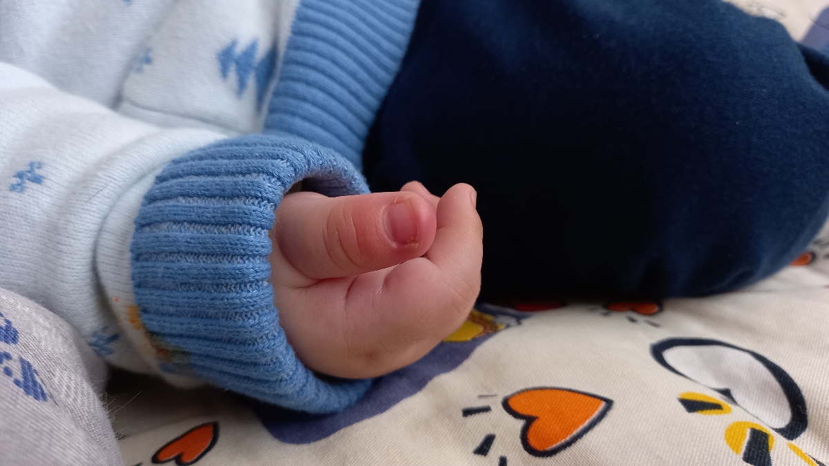 چرک کردن ناخن نوزاد چهار ماهه