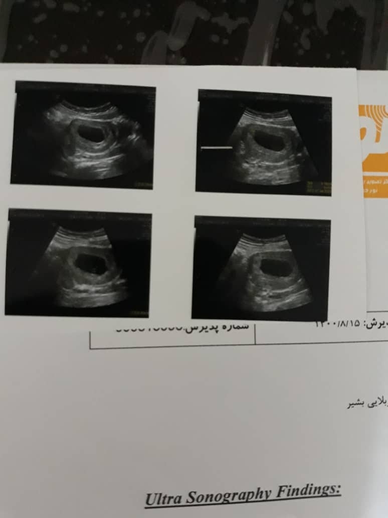 خون سیاه بعد ازنزدیکی دربارداری طبیعی است؟ خون سیاه بعد ازنزدیکی دربارداری طبیعی است؟