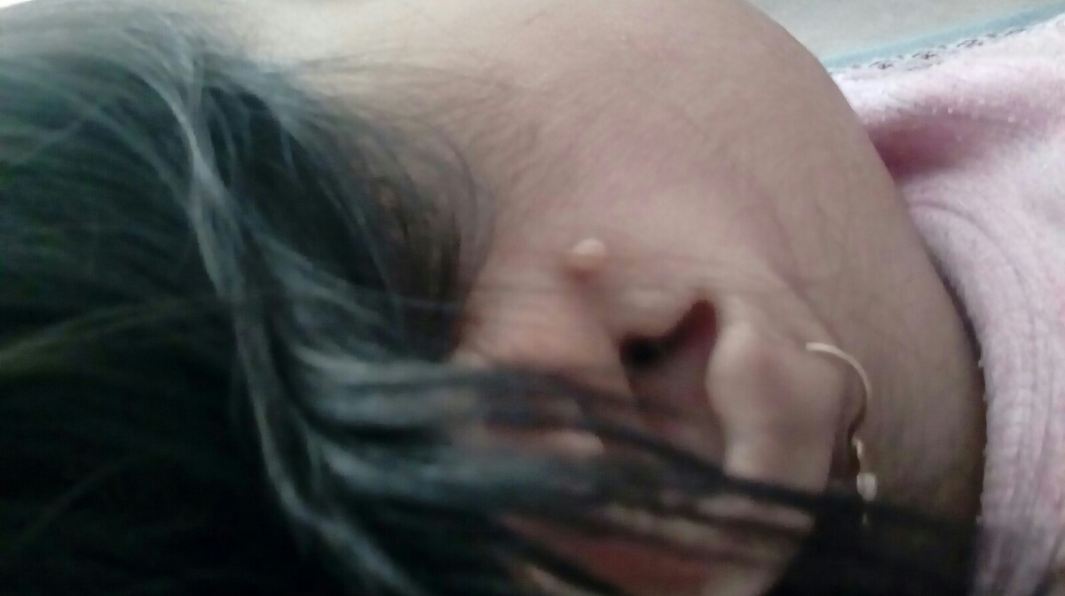 زگیل مادر زادی کنار گوش