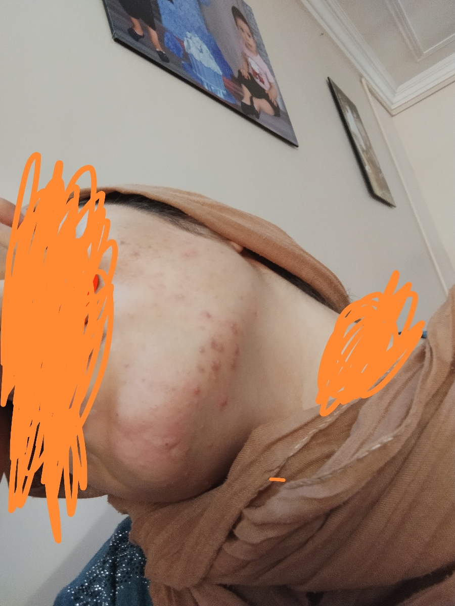 جوش زدن زیاد صورت