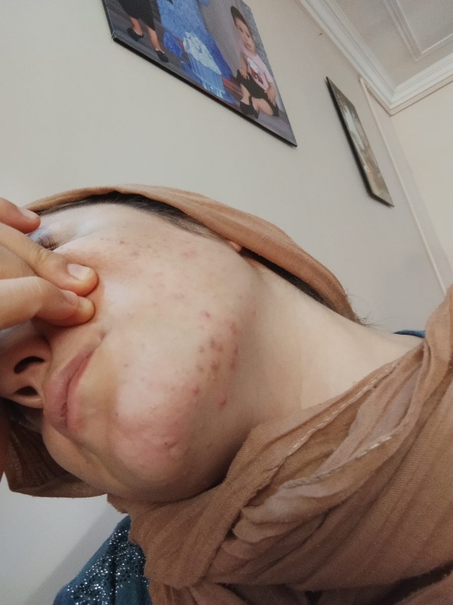 جوش زدن زیاد صورت
