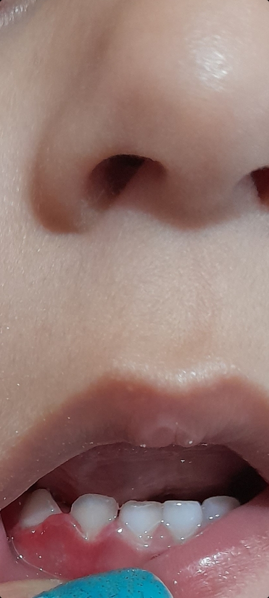 آفت یاقارچ دهان کودک آفت یاقارچ دهان کودک