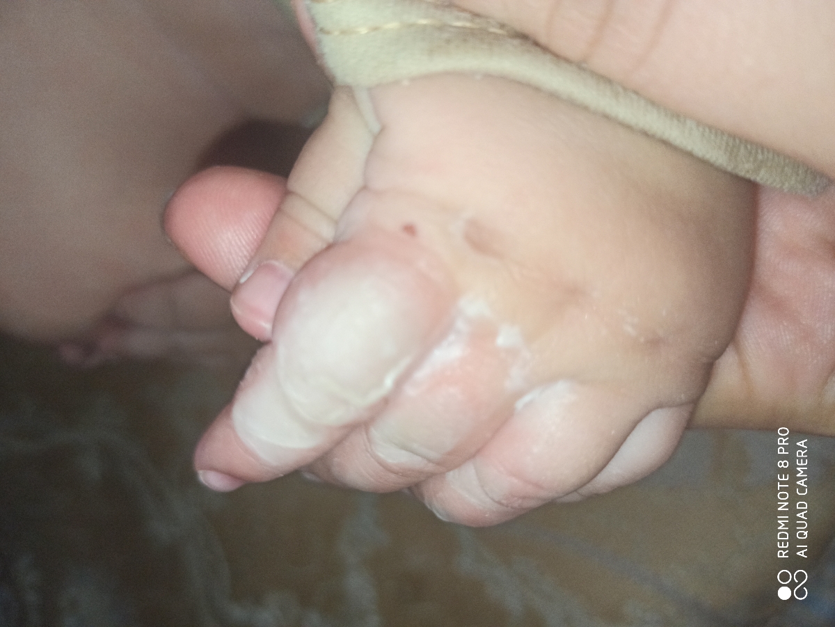 سوختگی دست نوزاد هشت ماه سوختگی دست نوزاد هشت ماه