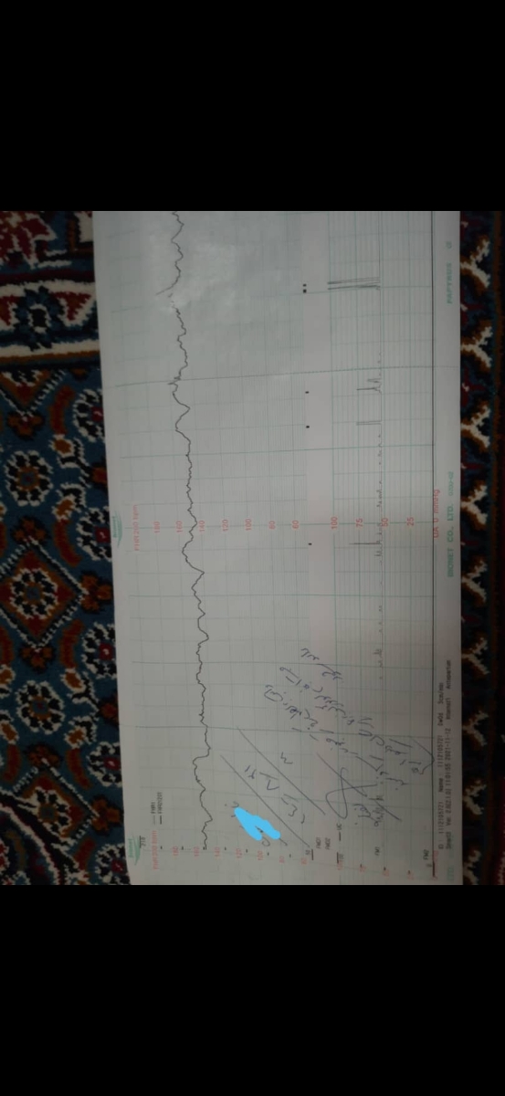 تفسیر nst و کاهش حرکات جنین