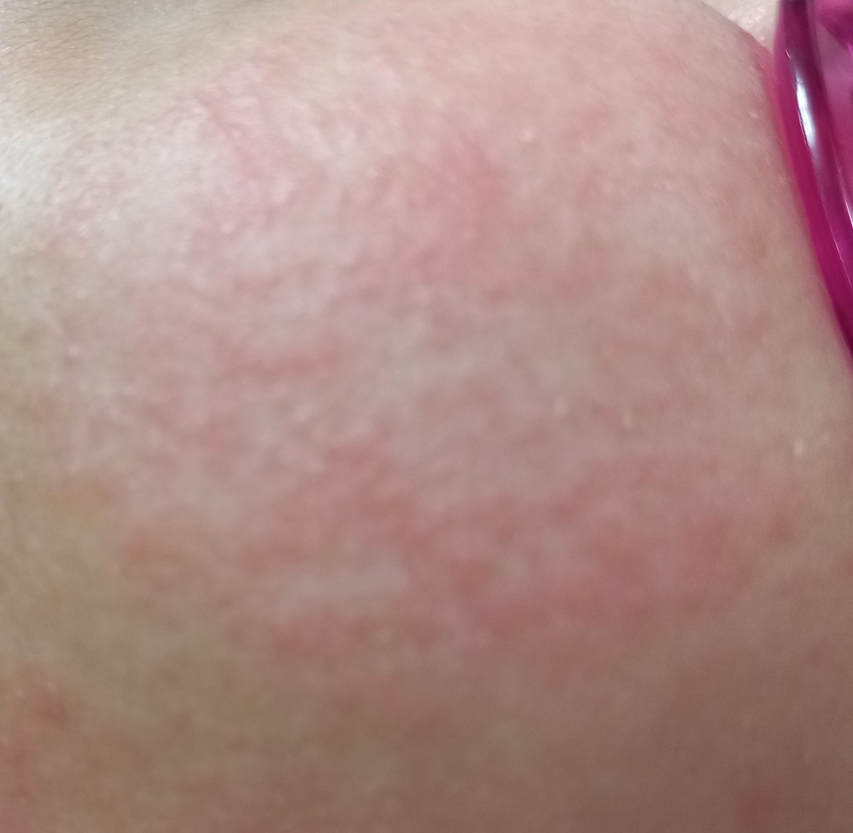 قرمز شدن پوست صورت نوزاد قرمز شدن پوست صورت نوزاد