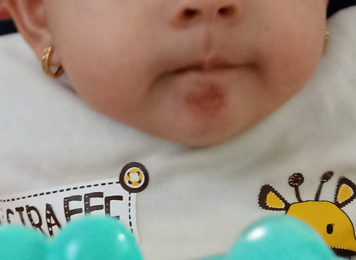 آبریزش آب دهان و جوش روی چونه آبریزش آب دهان و جوش روی چونه