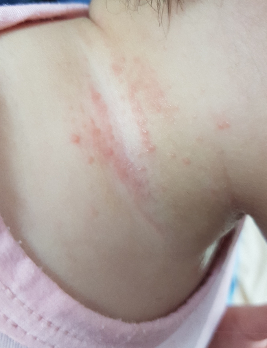 جوش ریز قرمز رنگ😪😪😪😪😪😪😪😢😢😢😢 جوش ریز قرمز رنگ😪😪😪😪😪😪😪😢😢😢😢