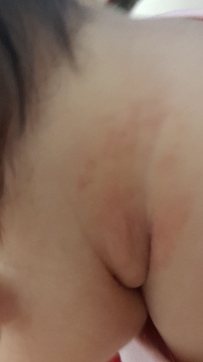 جوش ریز قرمز رنگ😪😪😪😪😪😪😪😢😢😢😢 جوش ریز قرمز رنگ😪😪😪😪😪😪😪😢😢😢😢