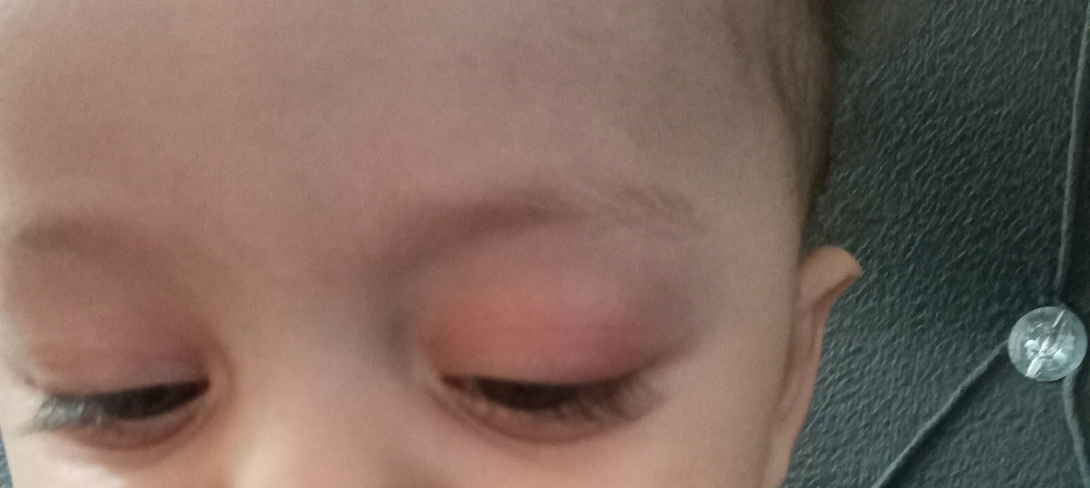 سلام وعرض ادب خدمت پزشک اوما دیروز بالای پلک پسرم قرمز شد