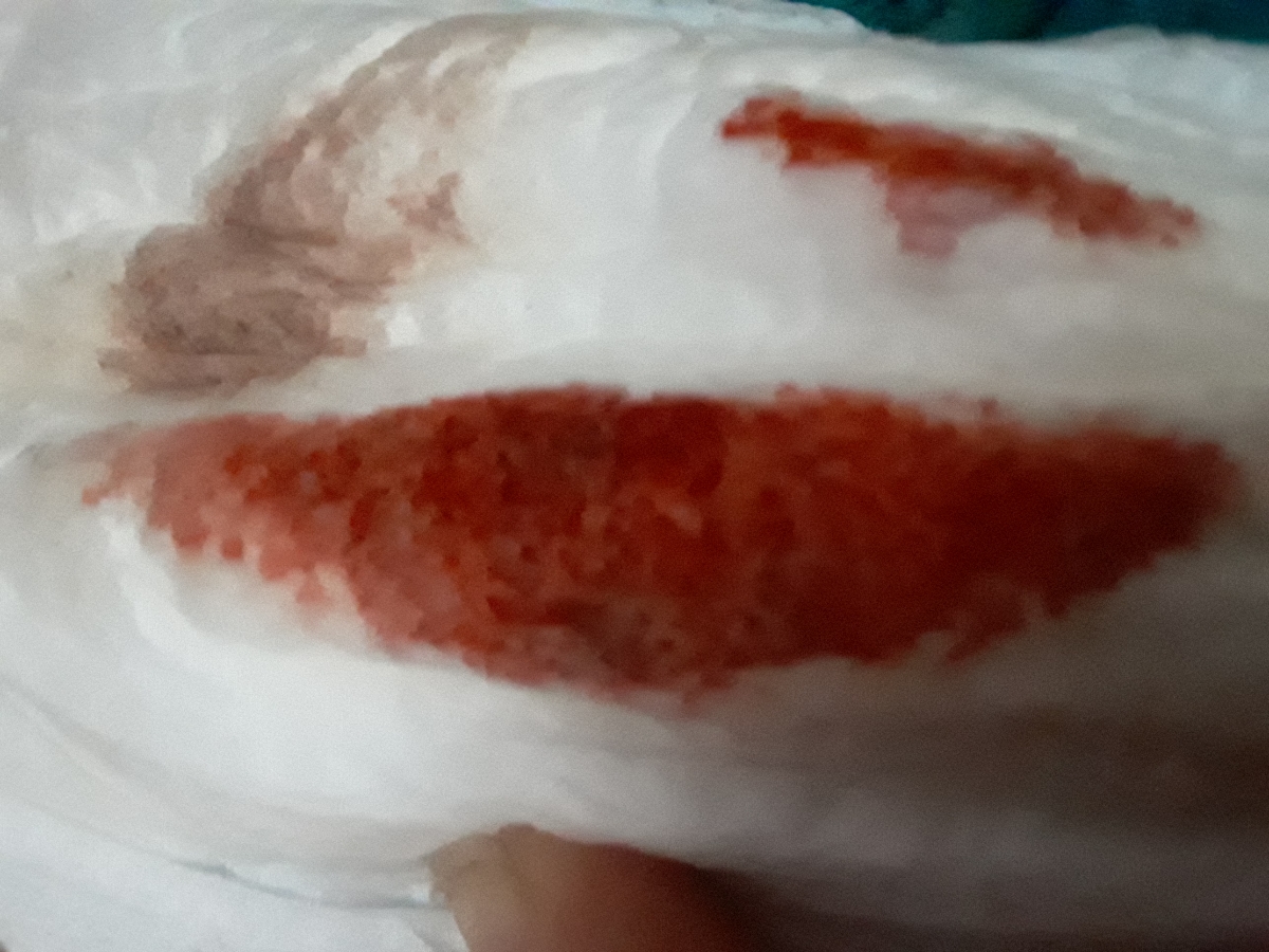 بتای ۸۱ و خونریزی بتای ۸۱ و خونریزی