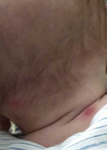 جوشهای بزرگ و بعضیا سر سیاه نوزاد ۷ ماهه جوشهای بزرگ و بعضیا سر سیاه نوزاد ۷ ماهه