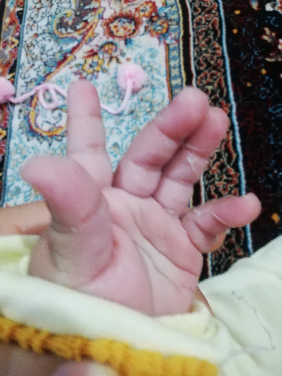 پوسته پوسته شدن دست نوزاد پوسته پوسته شدن دست نوزاد