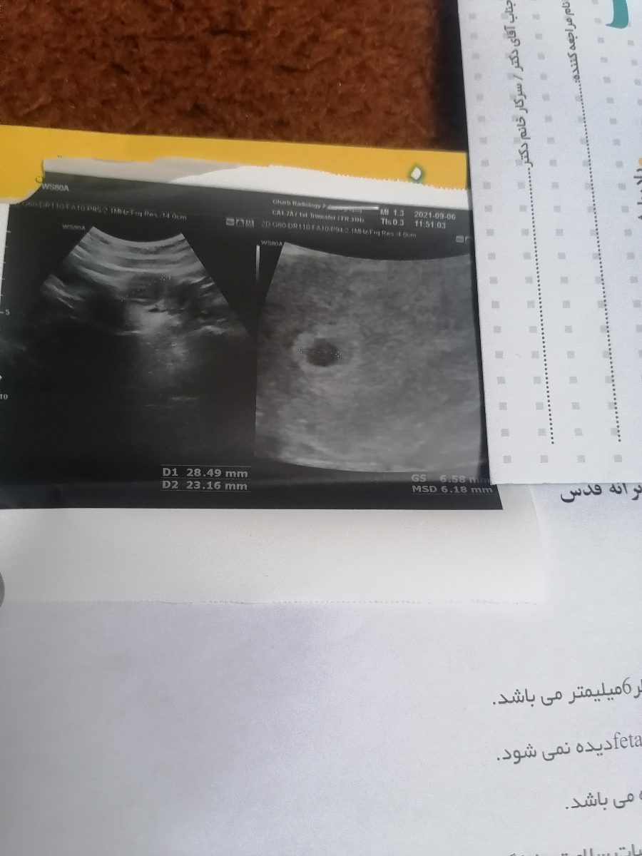 ساک بارداری وکیست ساک بارداری وکیست