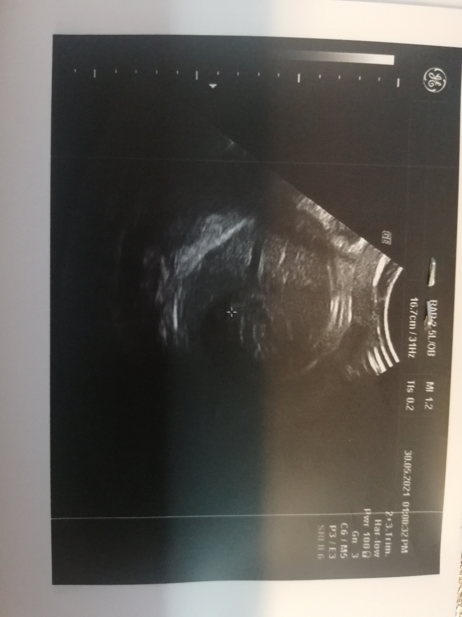 تعیین تاریخ سزارین باتوجه به سونو