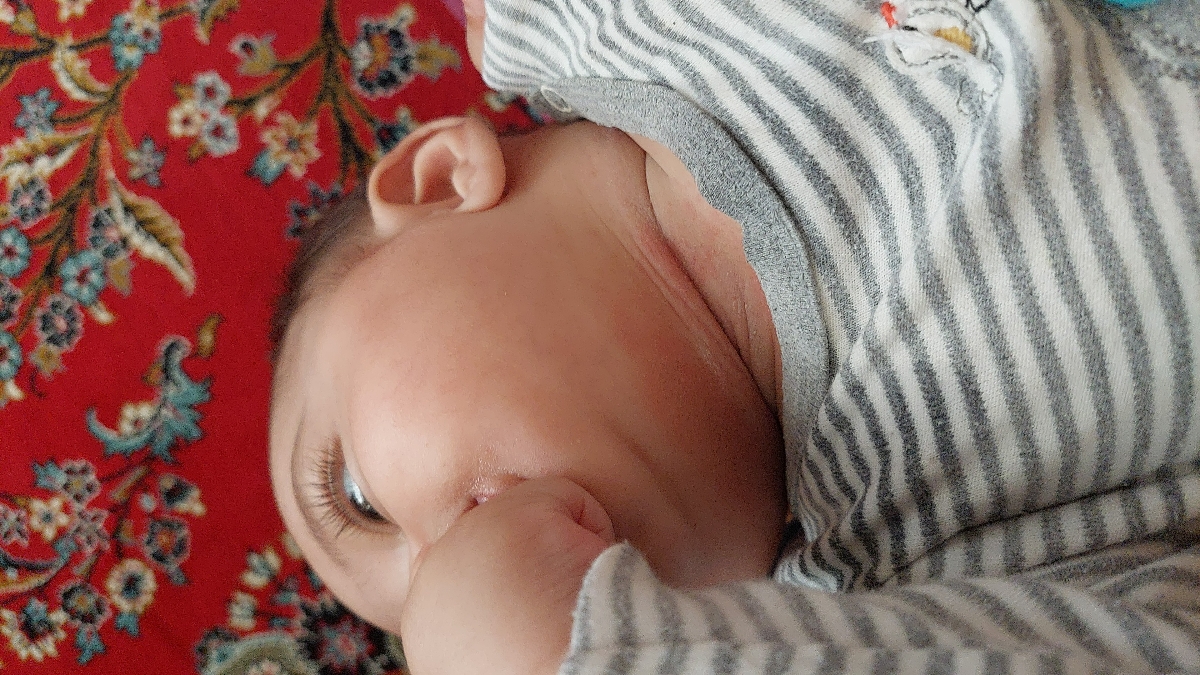 سوختگی گردن نوزاد ۵ونیم ماهه سوختگی گردن نوزاد ۵ونیم ماهه