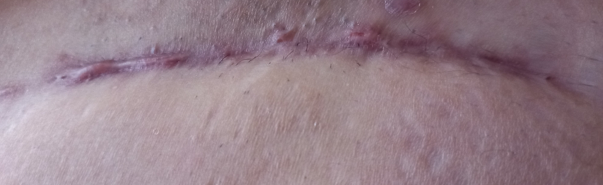 خارش بخیه سزارین