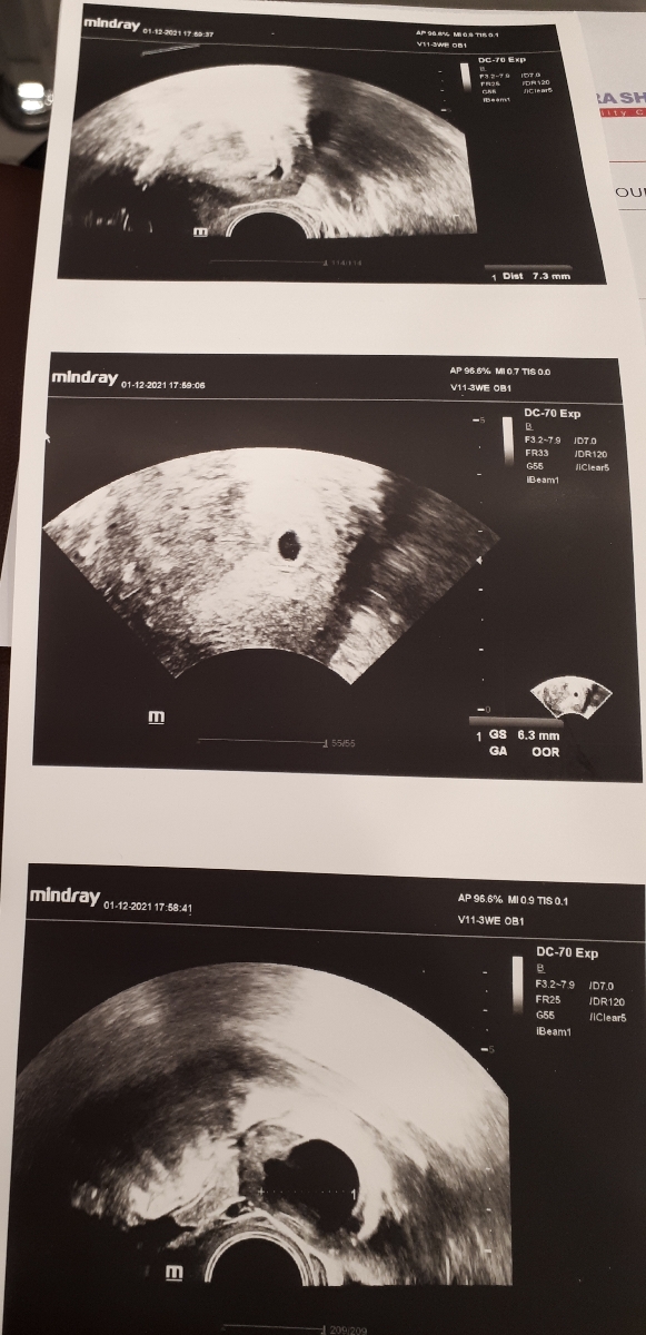 هماتوم کوچک در بارداری