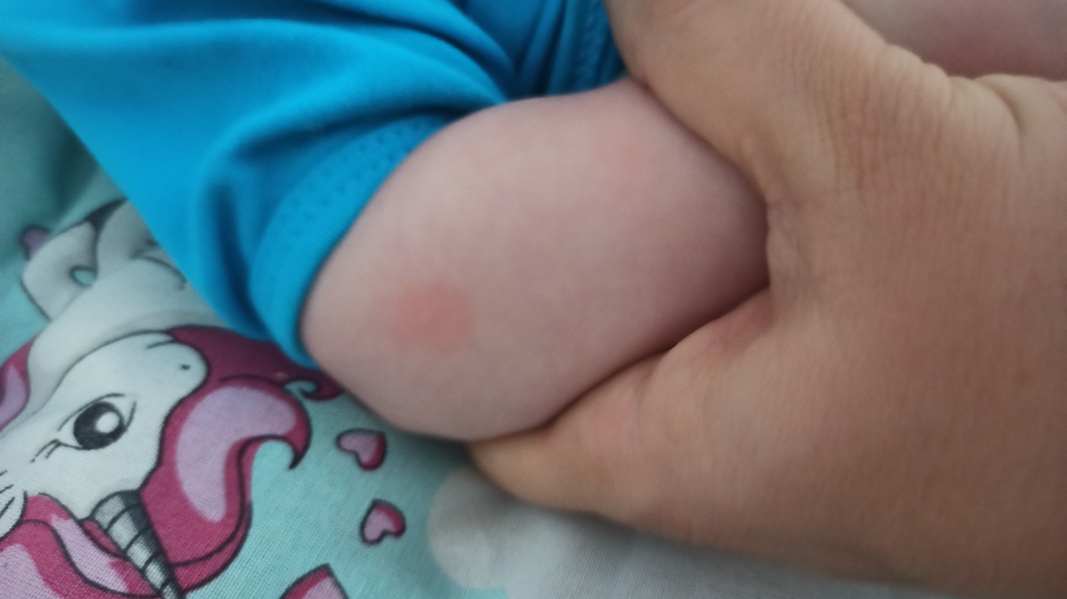 جوش روی بدن نوزاد