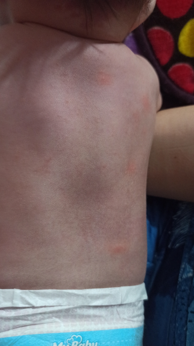 جوش روی بدن نوزاد