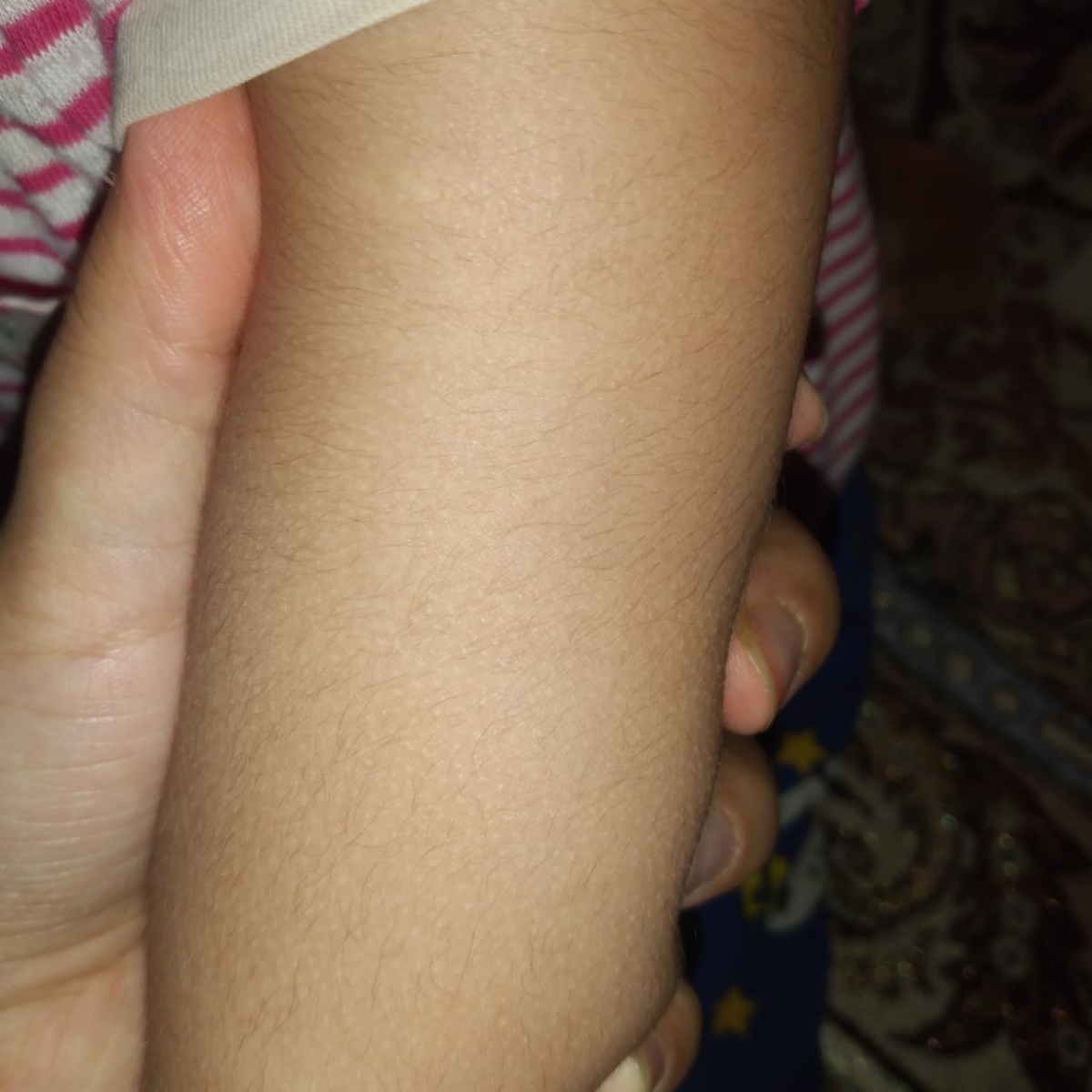 پوست مرغی شدن پوسته کودک دوساله