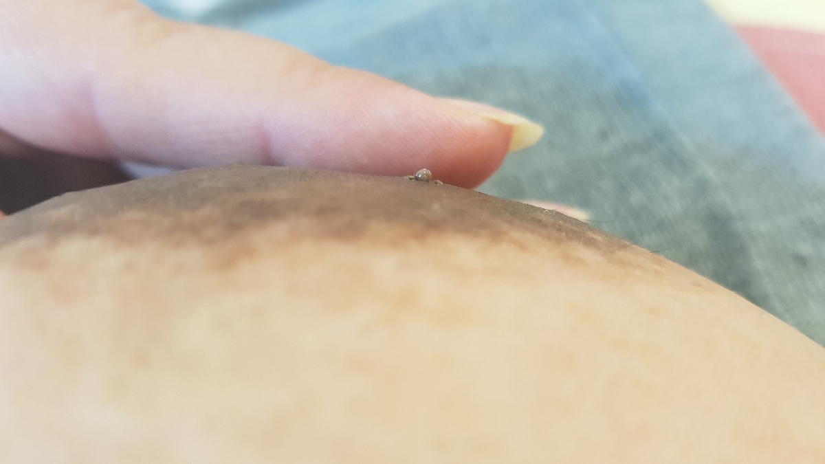 سلام پزشک اوما رو سینم این زگیل مانند در اومده چیکارش کنم؟ سلام پزشک اوما رو سینم این زگیل مانند در اومده چیکارش کنم؟