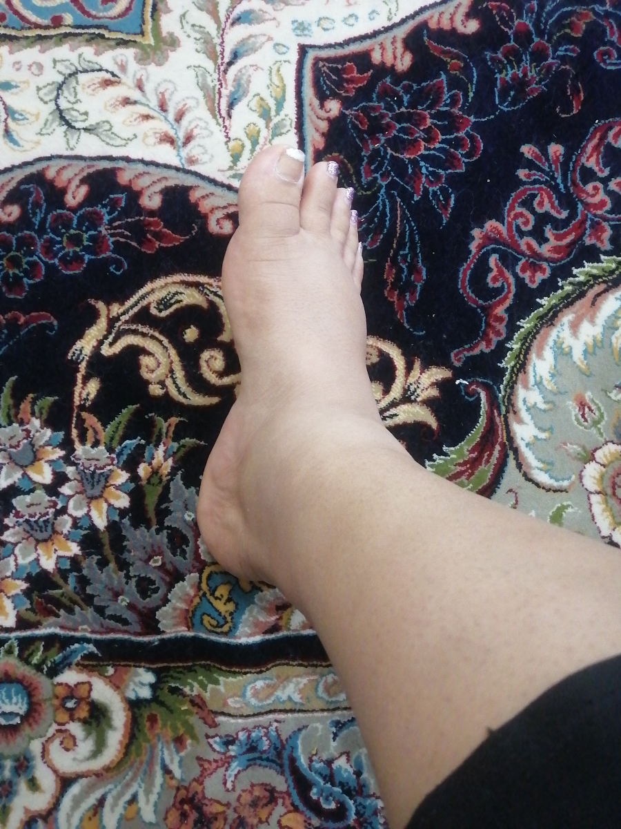 دوروز زایمان کردم ورم شدید پاهام و دوروز زایمان کردم ورم شدید پاهام و