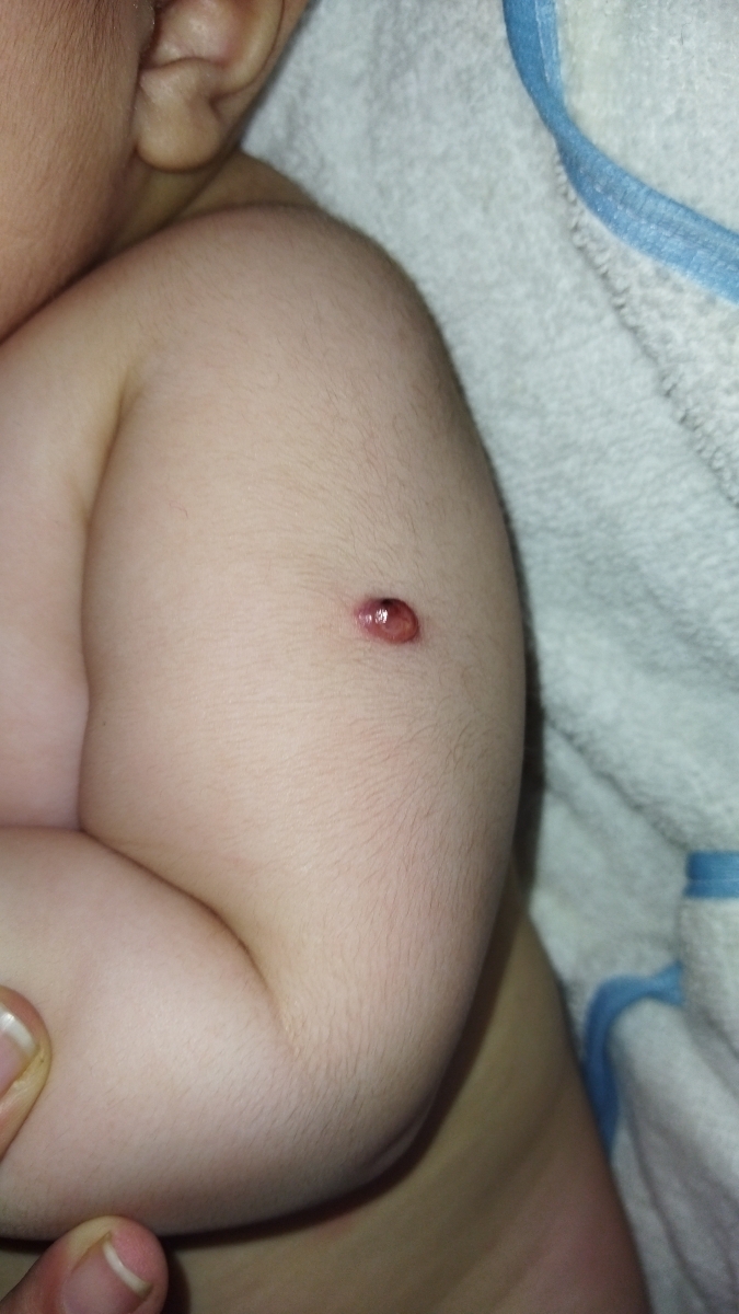 دکتر جای واکسن پسرم عفونت کرده ایا؟ دکتر جای واکسن پسرم عفونت کرده ایا؟