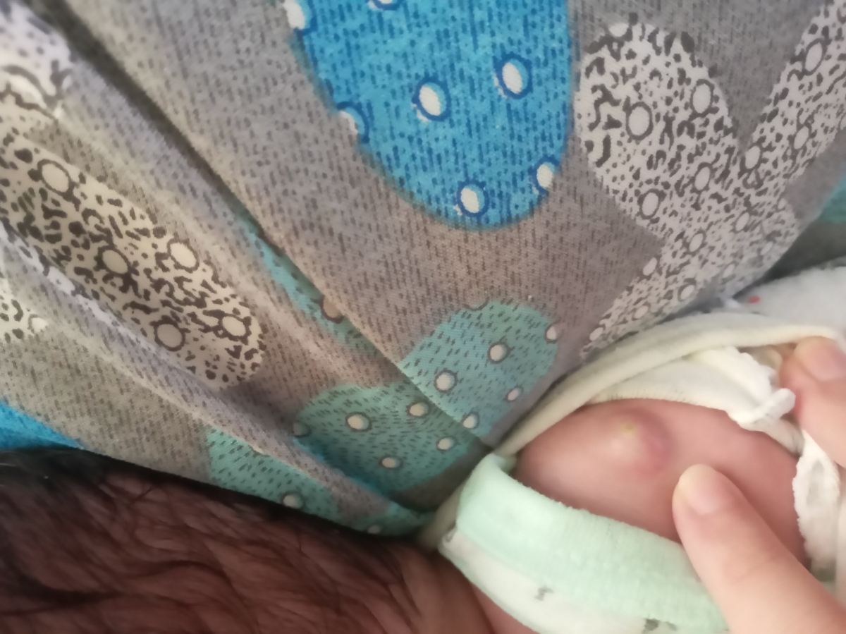 چرکی شدن واکسن بدو تولد نوزاد