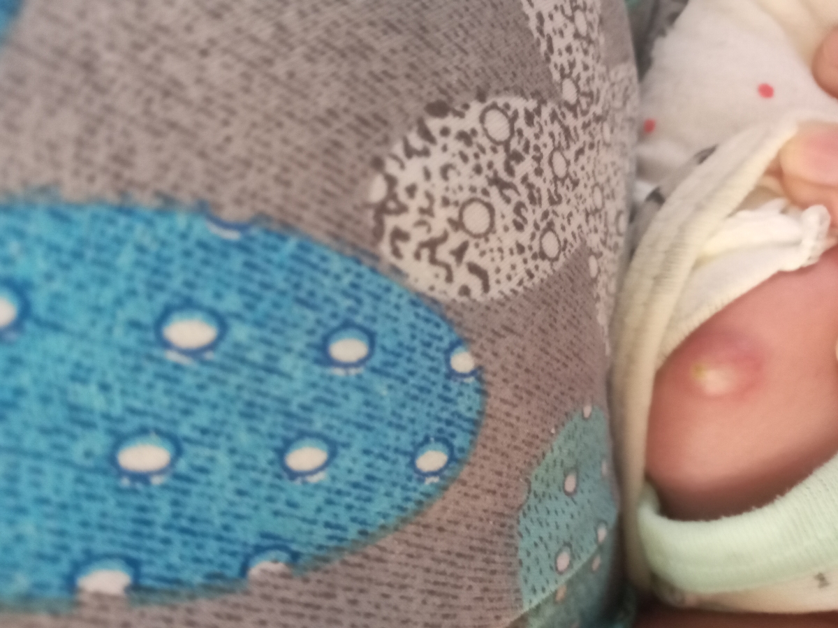 چرکی شدن واکسن بدو تولد نوزاد